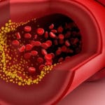 Lipids Management European Style EAS European Atherosclerosis Study President Interviewed